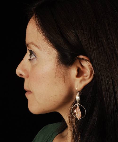after rhinoplasty female patient left side view case 5163