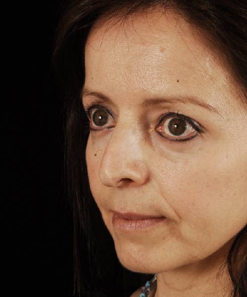 before rhinoplasty female patient left angle view case 5163