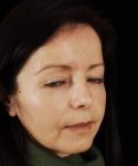 after rhinoplasty female patient right angle view case 5163
