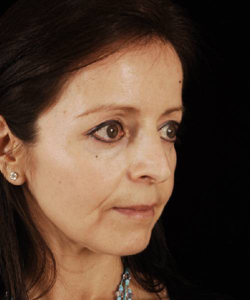 before rhinoplasty female patient right angle view case 5163