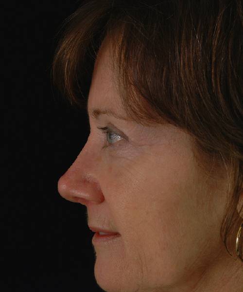after rhinoplasty female patient left side view case 5172