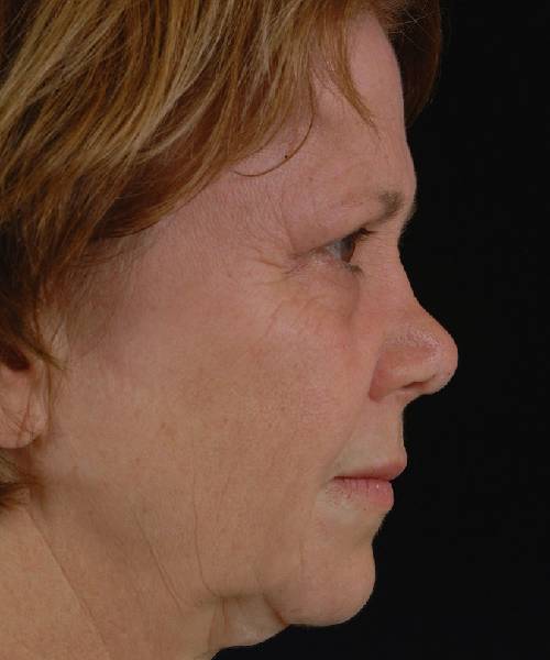 before rhinoplasty female patient right side view case 5188