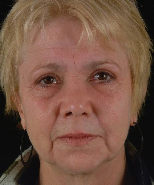 after rhinoplasty female patient front view case 5188