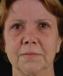 before rhinoplasty female patient front view case 5188