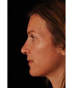 after rhinoplasty female patient left side view case 5193