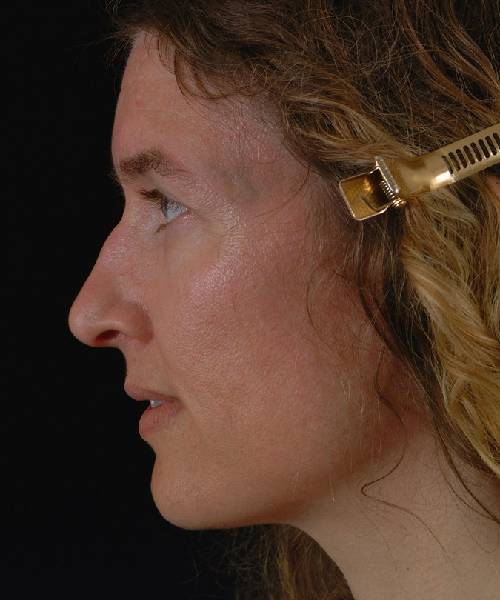 before rhinoplasty female patient left side view case 5193