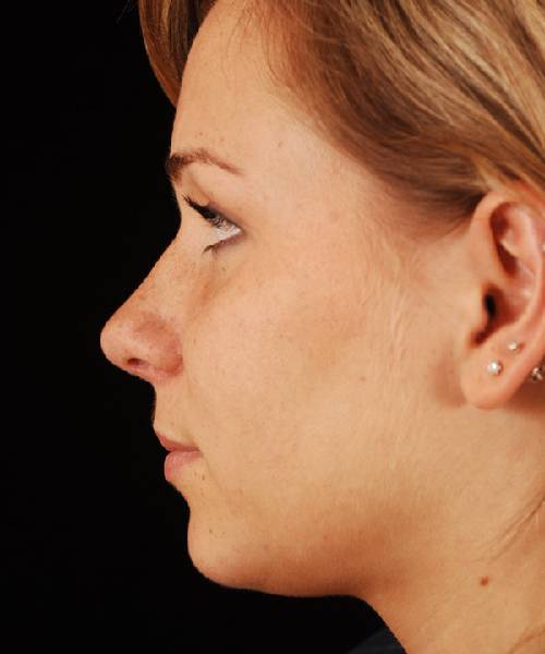 after rhinoplasty female patient left side view case 5196