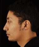 after rhinoplasty male patient left side view case 5199