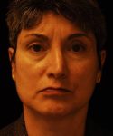 before rhinoplasty female patient front view case 5204