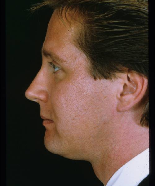 after rhinoplasty male patient left side view case 5212