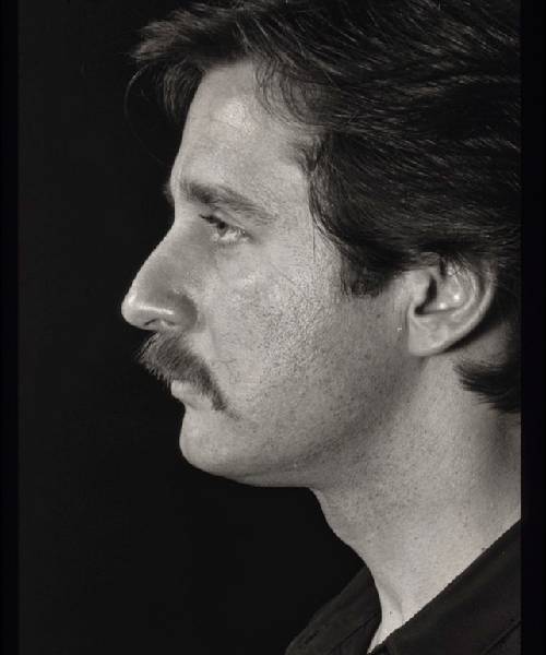 before rhinoplasty male patient left side view case 5212
