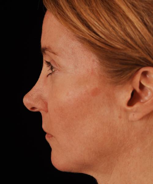 before rhinoplasty female patient left side view case 5218