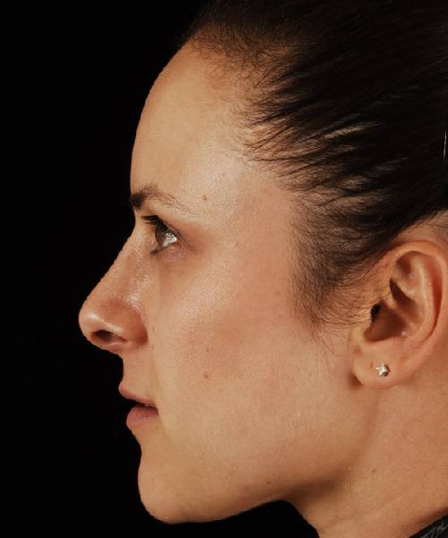 after rhinoplasty female patient left side view case 5223