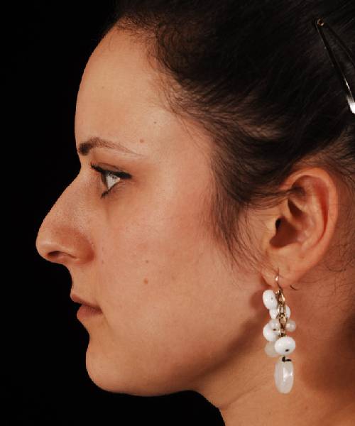 before rhinoplasty female patient left side view case 5223