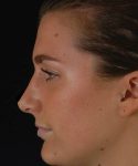 after rhinoplasty female patient left side view case 5226