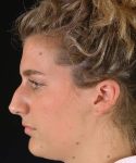 before rhinoplasty female patient left side view case 5226