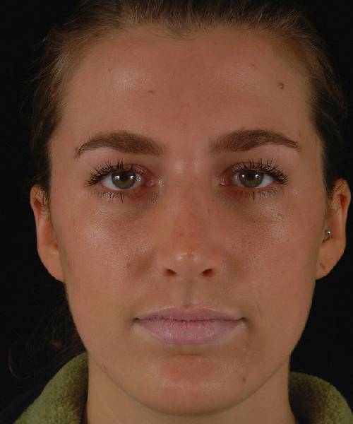 after rhinoplasty female patient front view case 5226