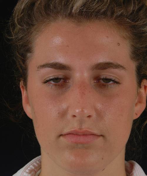 before rhinoplasty female patient front view case 5226