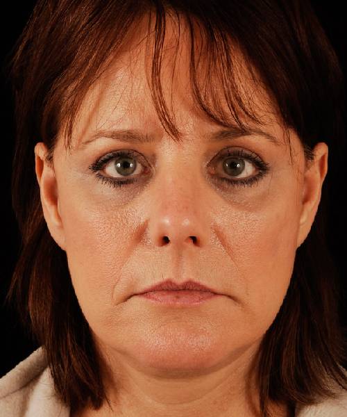 after rhinoplasty female patient front view case 5236