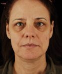 before rhinoplasty female patient front view case 5236