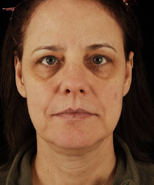 before rhinoplasty female patient front view case 5236