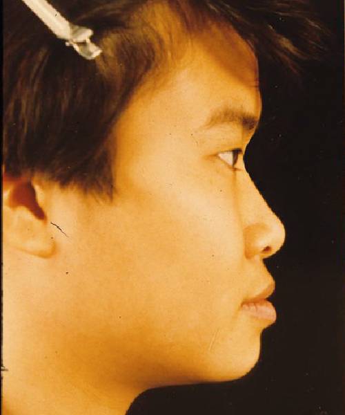 before rhinoplasty right side view case 5241