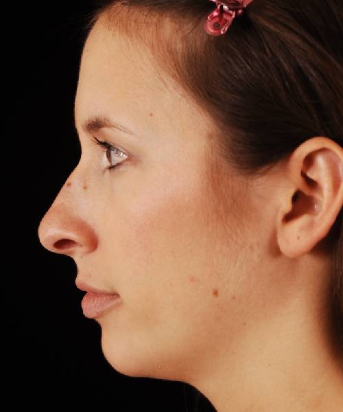 before rhinoplasty female patient left side view case 5249