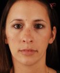 before rhinoplasty female patient front view case 5249