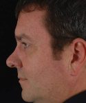 before rhinoplasty male patient left side view case 5254