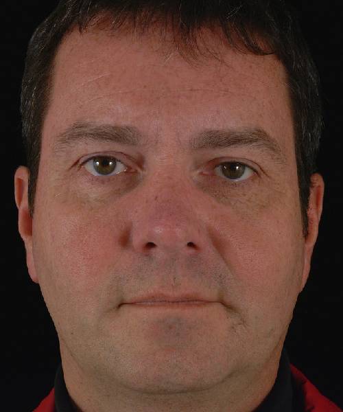 before rhinoplasty male patient front view case 5254