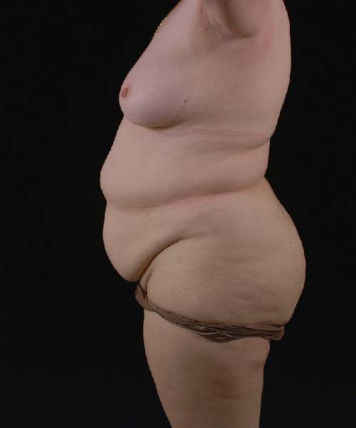 Before Tummy Tuck Female Patient Side Angle View Case 4681