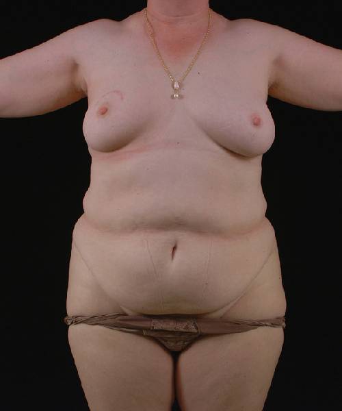 Before Tummy Tuck Female Patient Front Angle View Case 4681