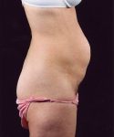 Before Tummy Tuck Female Patient Side Angle View Case 4686