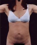 Before Tummy Tuck Female Patient Front Angle View Case 4686