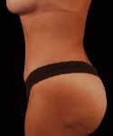 After Tummy Tuck Female Patient Side Angle View Case 4691