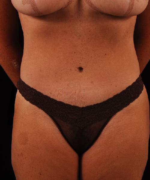 After Tummy Tuck Female Patient Front Angle View Case 4691