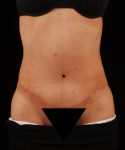 After Tummy Tuck Female Patient Front Angle View Case 4701