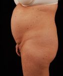 Before Tummy Tuck Female Patient Side Angle View Case 4706