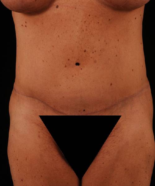 After Tummy Tuck Female Patient Front Angle View Case 4706