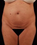 Before Tummy Tuck Female Patient Front Angle View Case 4706