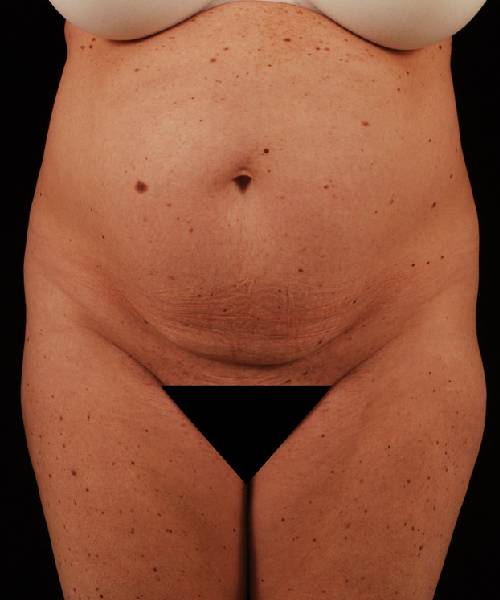 Before Tummy Tuck Female Patient Front Angle View Case 4706