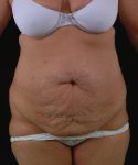 Before Tummy Tuck Female Patient Front Angle View Case 4717