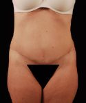 After Tummy Tuck Female Patient Front Angle View Case 4722