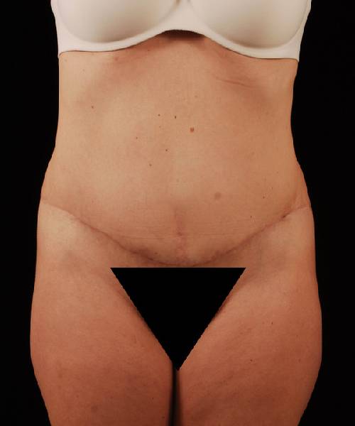 After Tummy Tuck Female Patient Front Angle View Case 4722