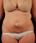 Before Tummy Tuck Female Patient Front Angle View Case 4722