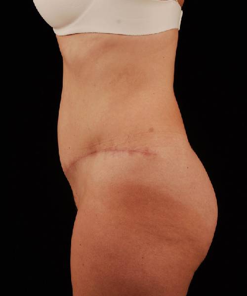 After Tummy Tuck Female Patient Side Angle View Case 4722