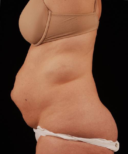 Before Tummy Tuck Female Patient Side Angle View Case 4722