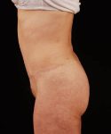 After Tummy Tuck Female Patient Side Angle View Case 4727