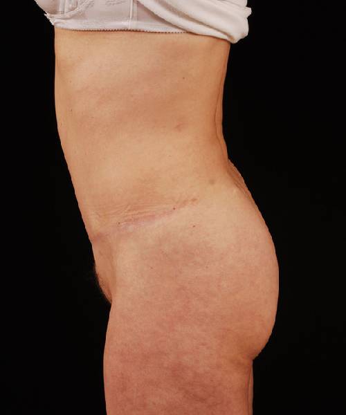 After Tummy Tuck Female Patient Side Angle View Case 4727