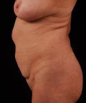 Before Tummy Tuck Female Patient Side Angle View Case 4727